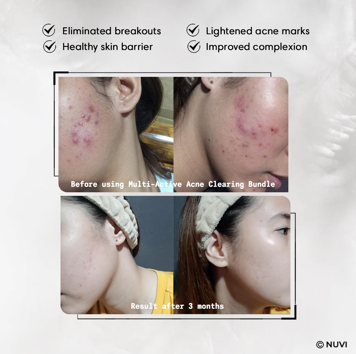 NUVI Multi-Active Acne Clearing Bundle