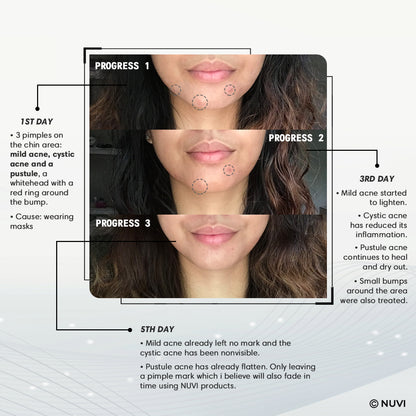 NUVI Multi-Active Acne Clearing Bundle