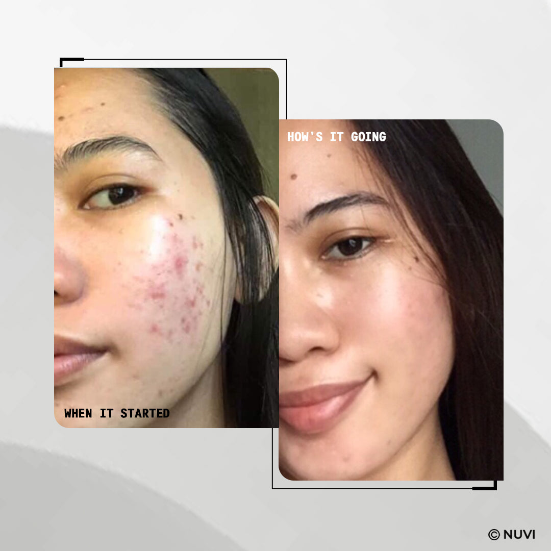 NUVI Multi-Active Acne Clearing Bundle