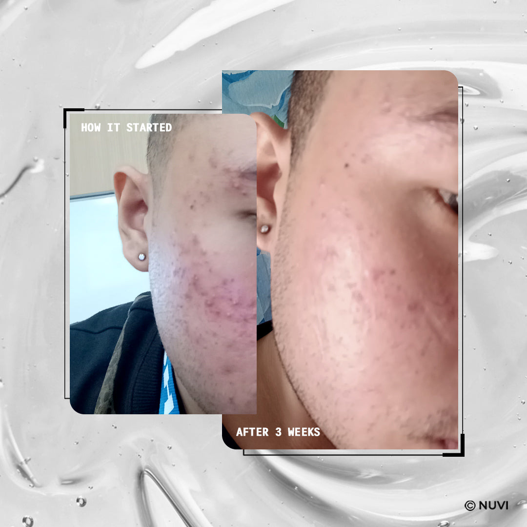 NUVI Multi-Active Acne Clearing Bundle